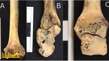 الكشف عن أقدم حالة التهاب مفاصل روماتويدي في مصر